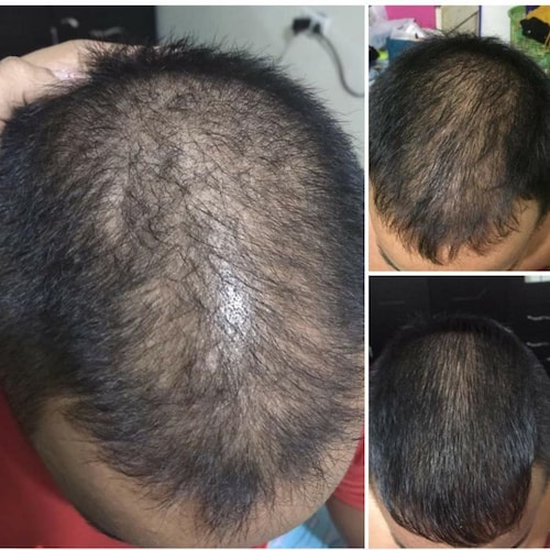MINOXIDIL 7% Crecimiento de Cabello CosmexLab Ultra Strong 60 ml 6 meses.