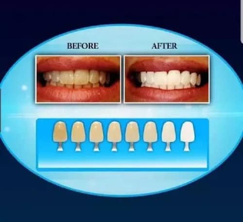 Kit De Blanqueamiento Dental Tratamiento Luz Led Dientes 20Minutos Aseo Higiene Bucal 