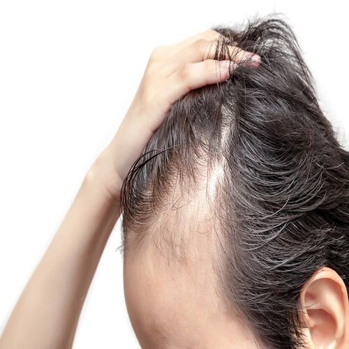 Minoxidil Crecimiento  De Cabello Con Bergamota y Biotina