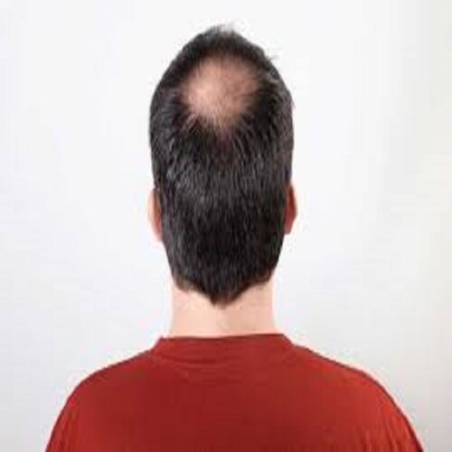 Minoxidil Crecimiento  De Cabello Con Bergamota y Biotina