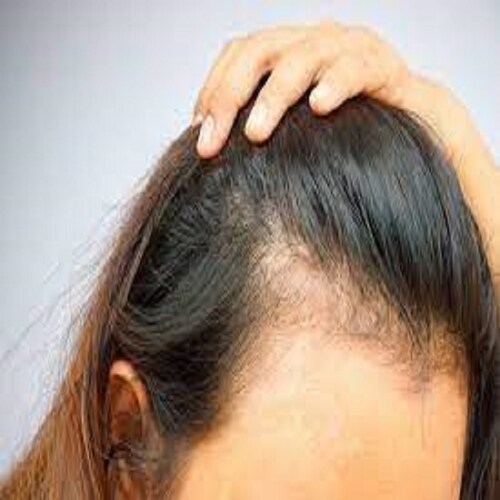 Minoxidil Crecimiento  De Cabello Con Bergamota y Biotina