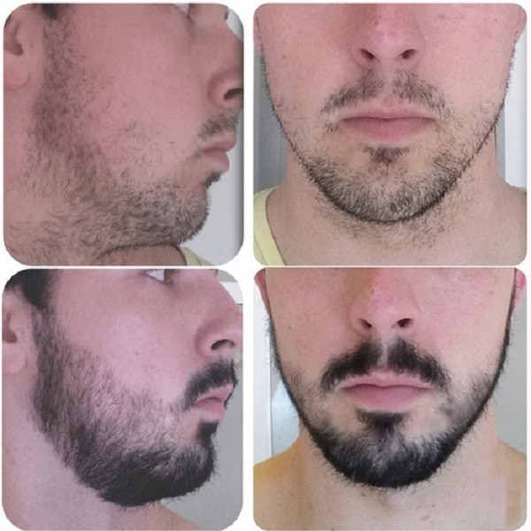 Minoxidil Crecimiento De Barba y Bigote