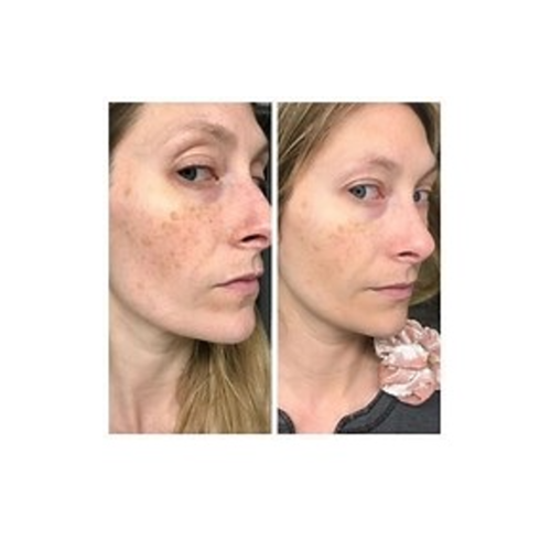 The Ordinary Retinol 1% in Squalane