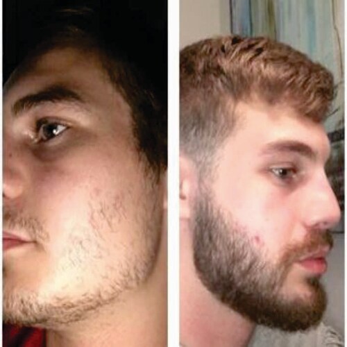 MINOXIDIL 7% Crecimiento Barba y Bigote CosmexLab Nature 60 mL 3 meses.