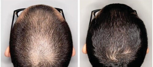 Minoxidil 2% Shampoo Anticaida y Anticaspa con Ketoconazol al 2%, Keratina, Arginina 250ml.