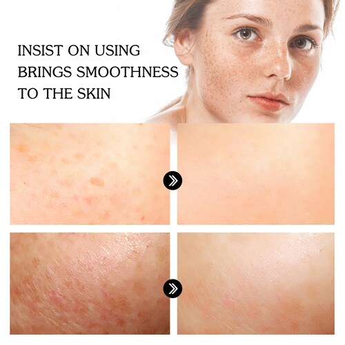 Serum blanqueador de pecas, elimina  manchas oscuras JAYSUING.