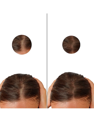 Minoxidil 5mg 30 Tabletas Minoxypark 6 Cajas