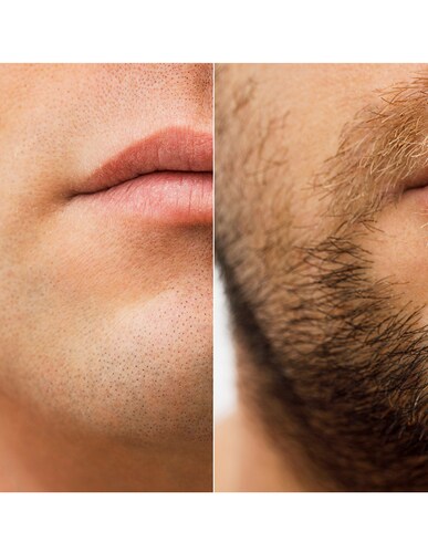 Minoxidil 5mg 30 Tabletas Minoxipark