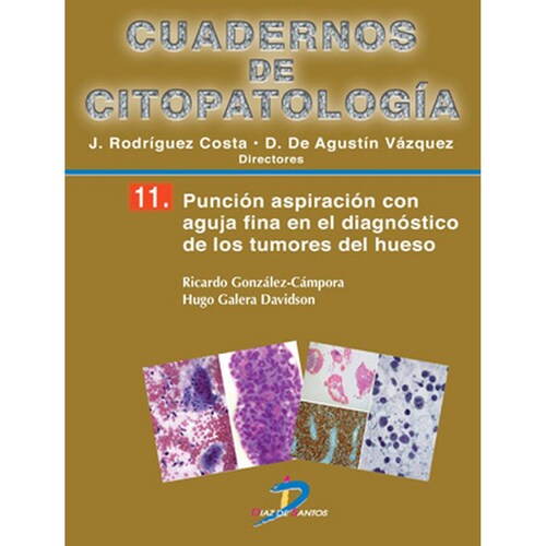 Punción aspiración con aguja fina en el diagnóstico de los tumores de hueso 