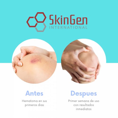 Hematix Gel 15g Desvanecedor De Moretones, Hematomas, Piel 