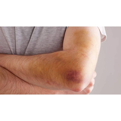 Hematix Gel 15g Desvanecedor De Moretones, Hematomas, Piel 
