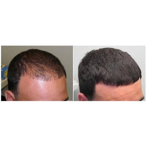 Paquete de Limpieza Capilar MXHGO-002-6 2xShampoo 250ml 2xLocion 100ml Unisex Botella de Plástico Uso Diario HairGrowth