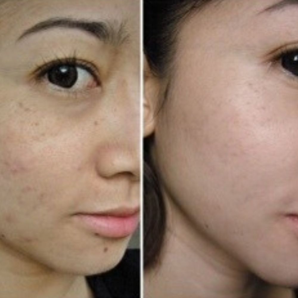Kit Thanaka Superior. Tratamiento para Corregir y Eliminar Manchas, Paño/Melasma y Cicatrices de Acné