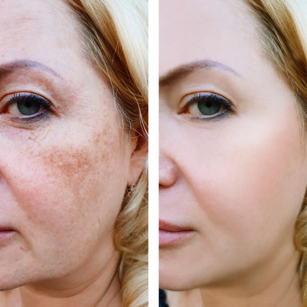 Kit Doble Granada. Rutina Nocturna. Tratamiento para Eliminar Manchas, Paño y Melasma. Reduce los Signos de Envejecimiento y Líneas de Expresión.