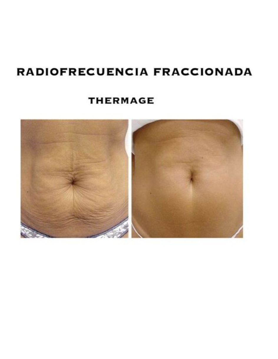 Radiofrecuencia Fraccionada Reafirmante Antiarrugas Estrias.