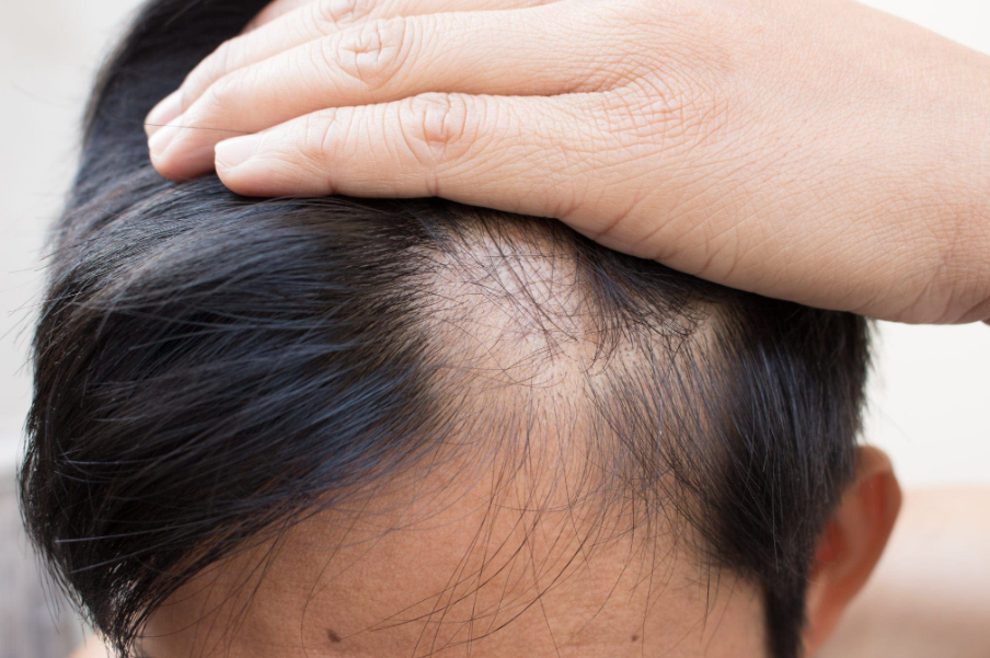 Foligain Trioxidil 10% triple acción con Bloqueador de Dht, Anti-adelgazamiento para Hombres con alopecia