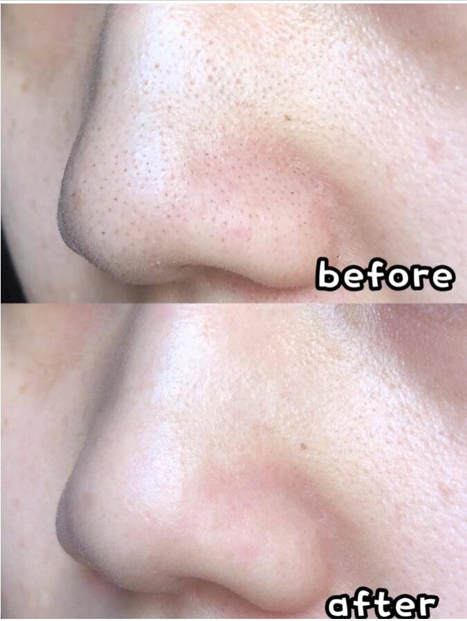 Hidrodermoabrasión Hydra Facial Acné Espinilla Hidrata Poros