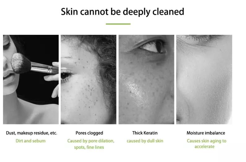 Hidrodermoabrasión Hydra Facial Acné Espinilla Hidrata Poros