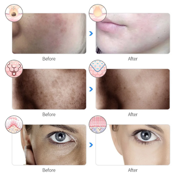 Mascarilla Facial LED Recargable, Máscara de belleza de terapia de fotones LED de 7 colores, Rejuvenecimiento de la Piel