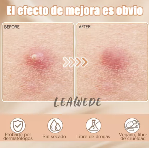 240pzs Mascarillas Estrella Para El Acne Espinillas Granos