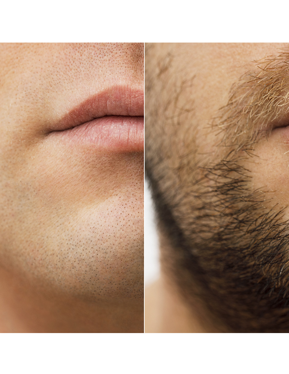 Minoxidil 2.5mg 30 Tabletas Mintop