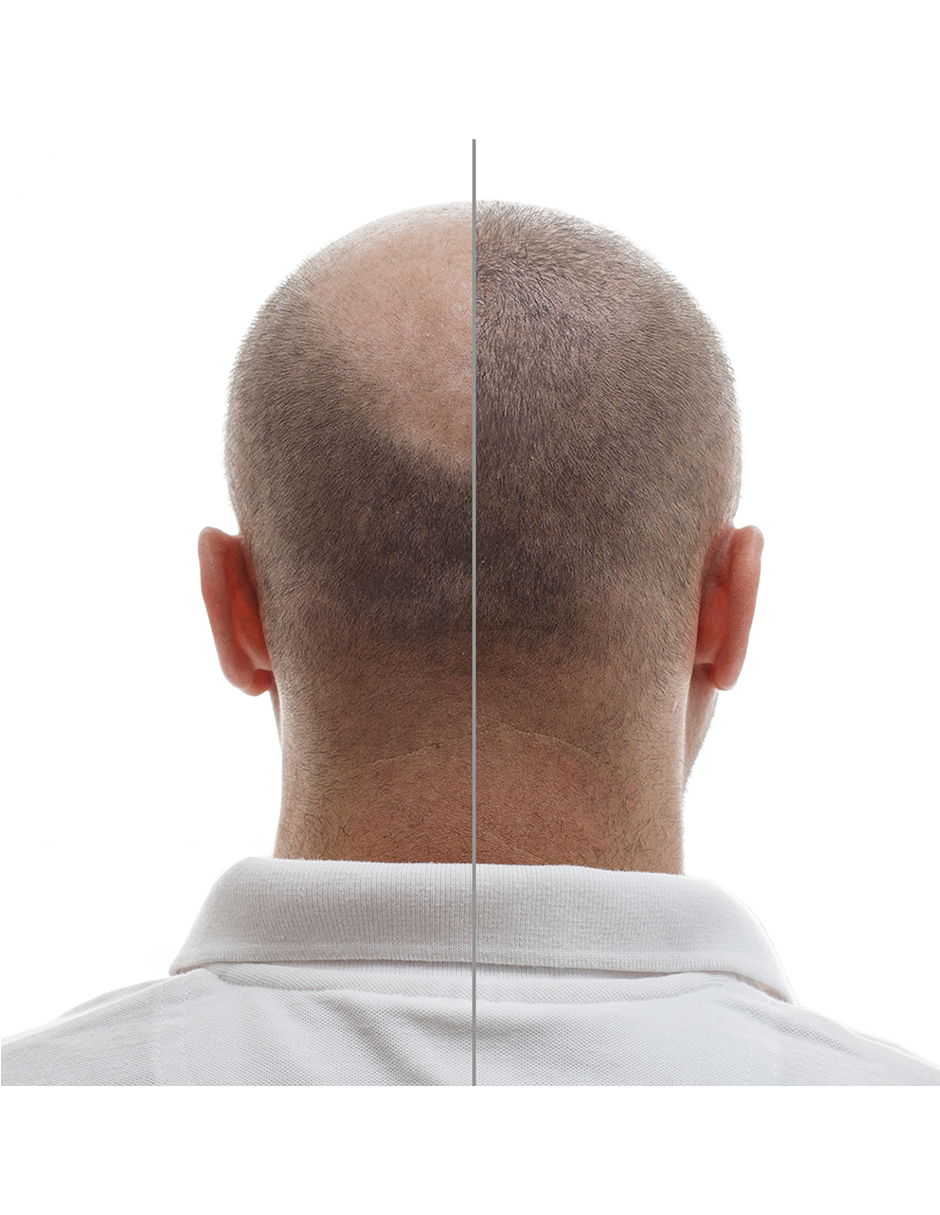 Minoxidil 5mg + Dutasterida 0.5mg 100 Tabletas