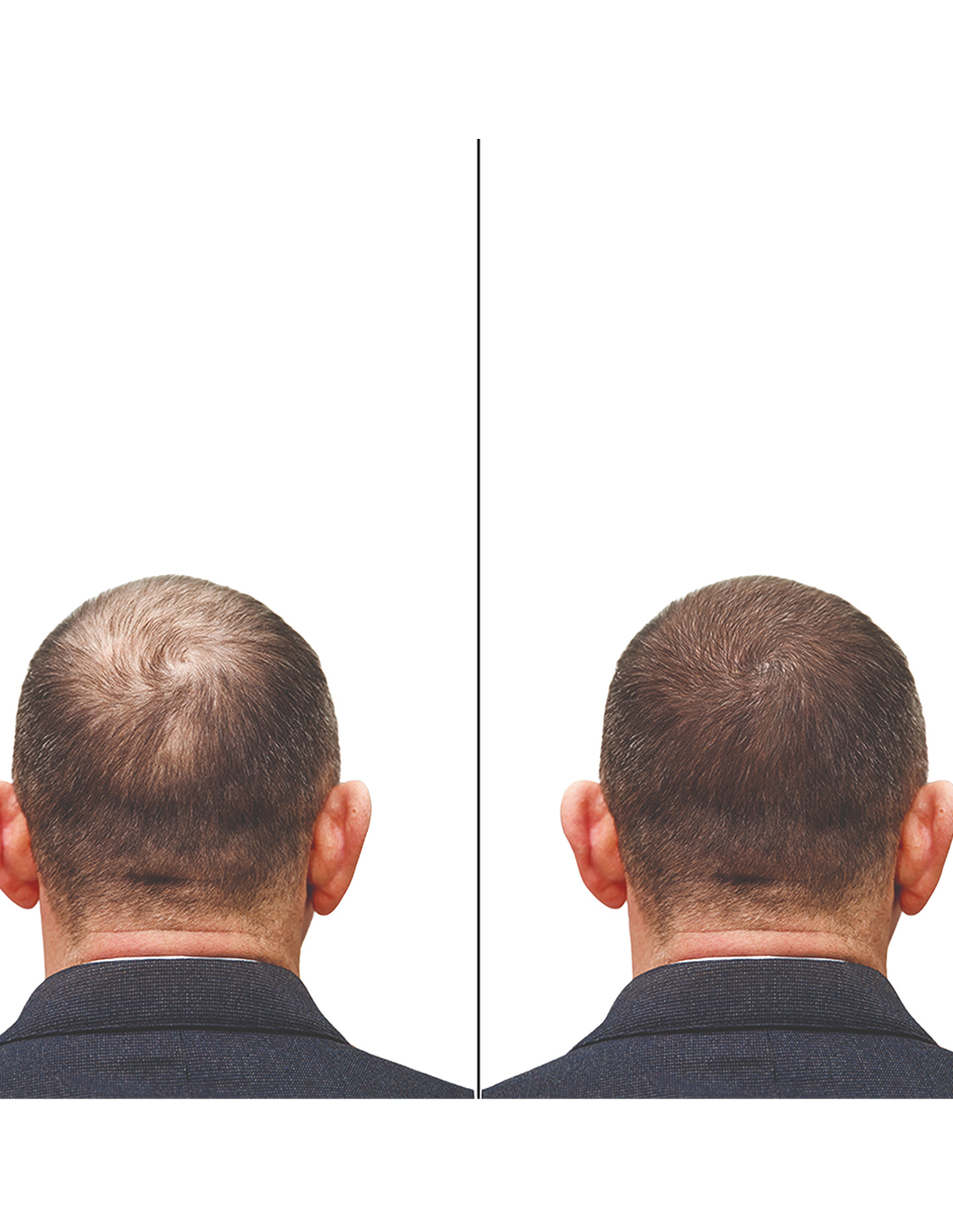 Minoxidil 5mg + Dutasterida 0.5mg 100 Tabletas