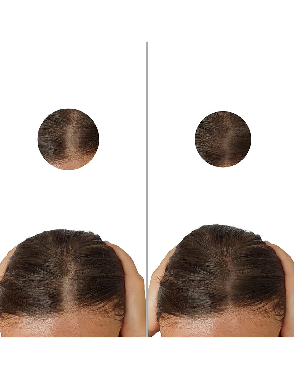 Minoxidil 5mg + Dutasterida 0.5mg 100 Tabletas
